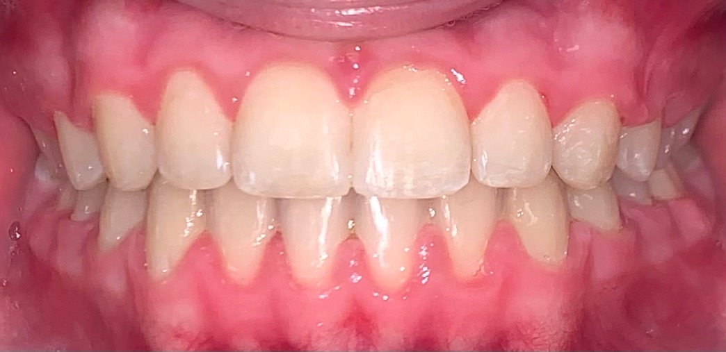 after Image