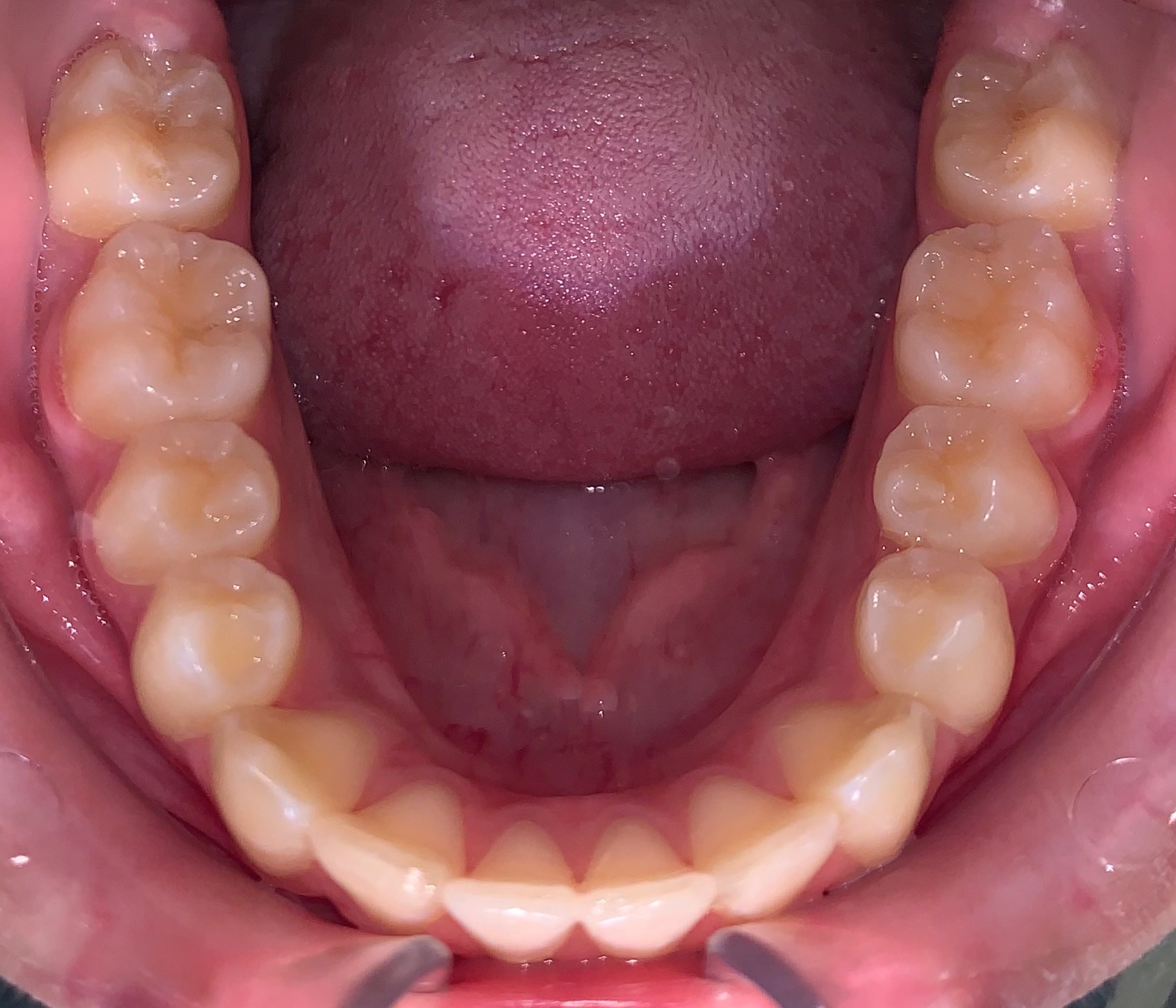 after Image