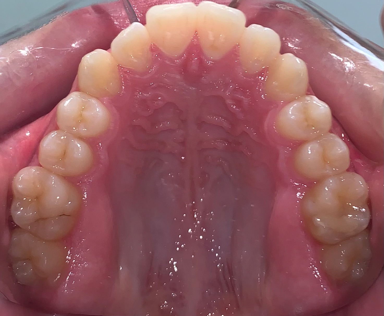 before Image