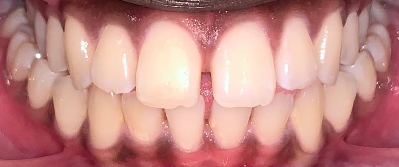 before Image