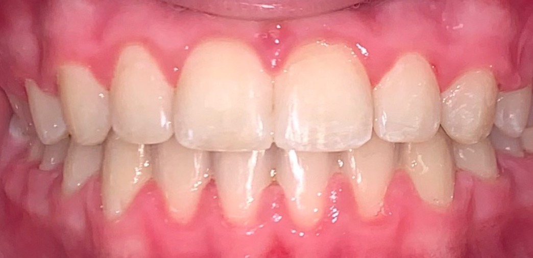 after Image